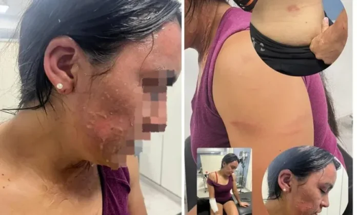 María Teresa Miranda fue agredida por dos mujeres que le arrojaron agua hervida en el rostro.